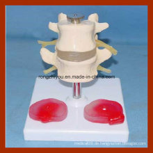 Natürliche Größe 2 Lendenwirbelsäule mit 3 Pathologic Disc Model